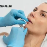 nasolabial fold filler